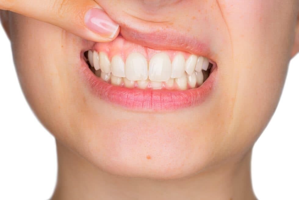 ¿Cuándo saber que se necesita una periodoncia?