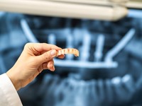 El futuro de los implantes dentales en nuestra clínica dental en Vigo